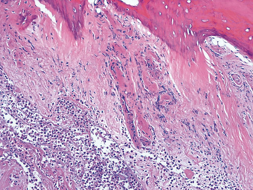 Pathology Outlines Bacterial osteomyelitis (acute)